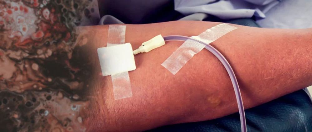 Blood Transfusion: Adverse Transfusion Reactions (ATRs)